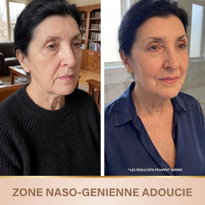 Zone naso-génienne adoucie