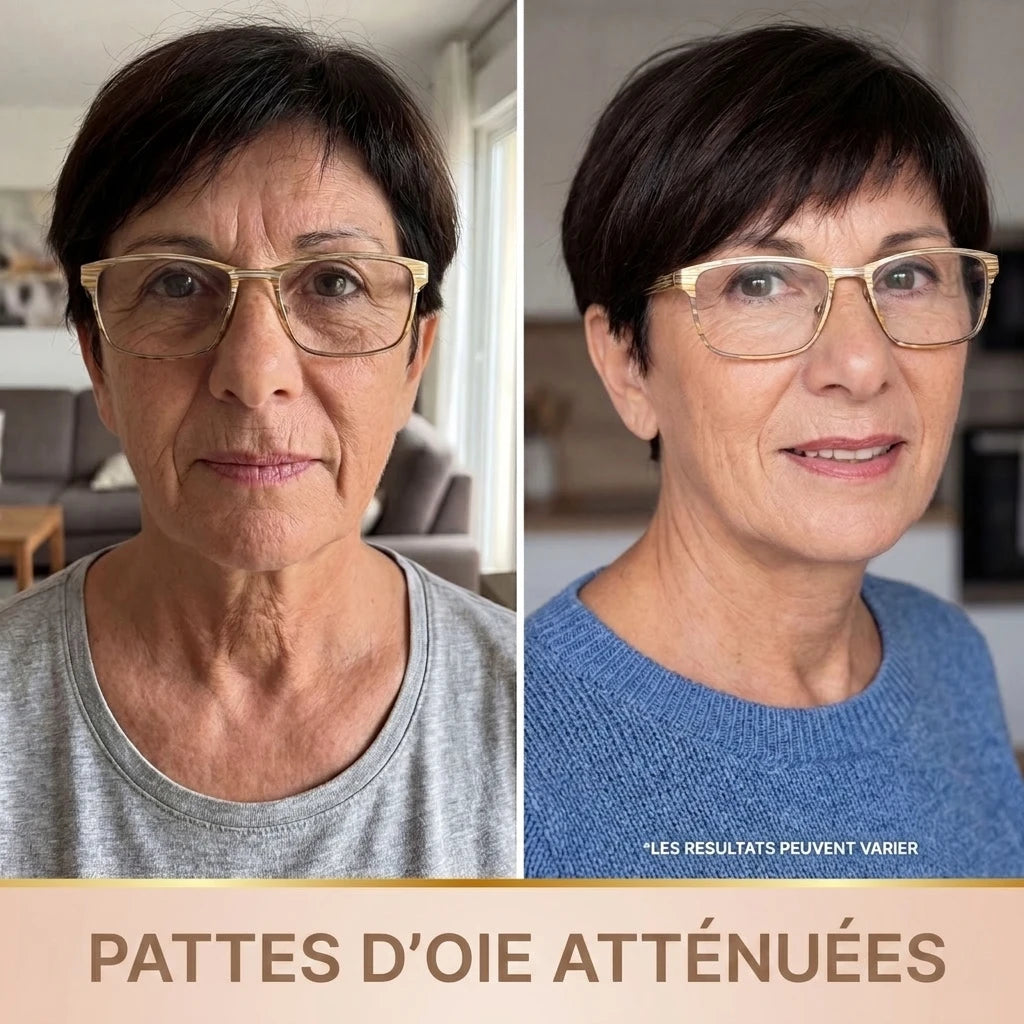 Pattes d'oie atténuées